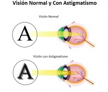 Astigmatismo